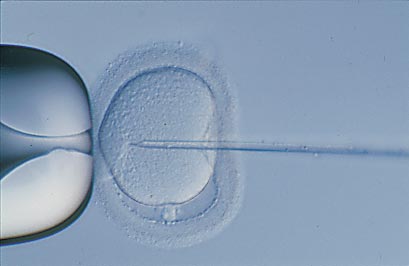 單一精蟲顯微注射（ICSI）