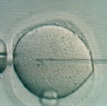 無精蟲症可以用非開刀的方式取得精子嗎？